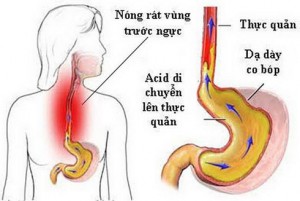 Biện pháp khắc phục chứng ợ chua tại nhà hiệu quả