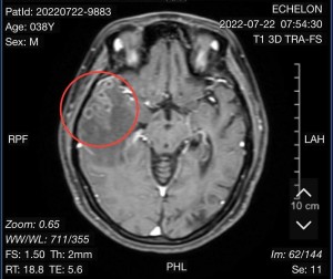 Phát hiện ký sinh trùng làm tổ trong não người phụ nữ sau cơn đau đầu