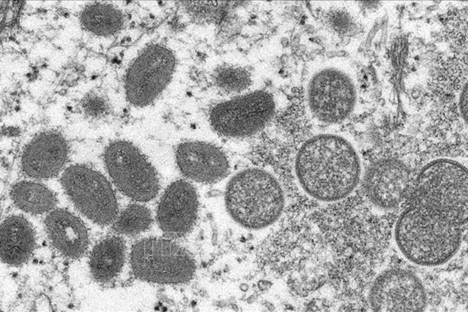 Hình ảnh dưới kính hiển vi cho thấy virus đậu mùa khỉ trong mẫu bệnh phẩm của một bệnh nhân. Ảnh minh họa: Reuters/TTXVN